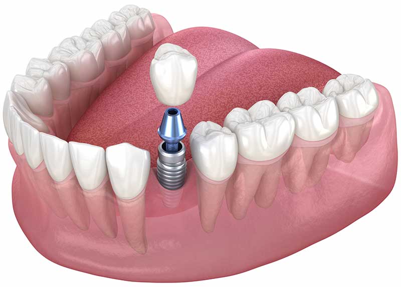 Er tannimplantat trygt for eldre?